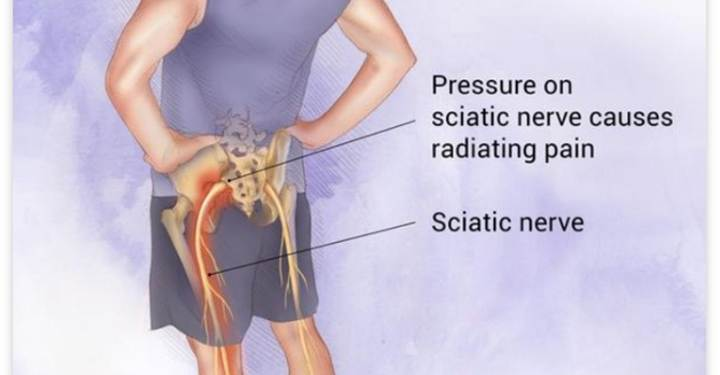 Don’t Let Sciatica Stop You: Practical Ways to Stay Active and Live With Less Pain